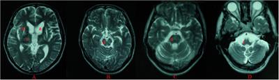 Sex Differences in Clinical Characteristics and Brain MRI Change in Patients With Wilson’s Disease in a Chinese Population